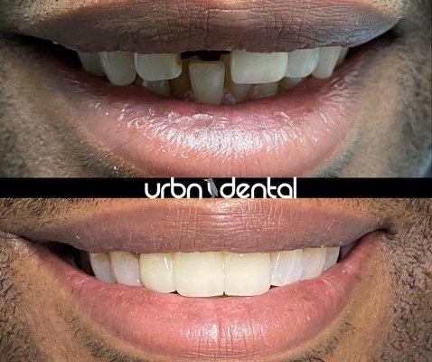 Witness the Radiant Transformation: Delight in the Joyful Smile of Our Satisfied Patient! URBN Dental here Proudly Serving You!