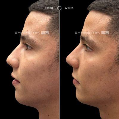 Non-Surgical Nose Job