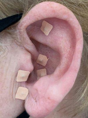 New service --Ear beads for a variety of conditions