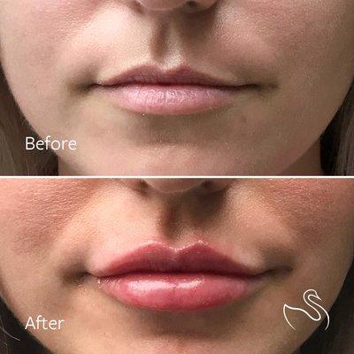 Lip Filler Results