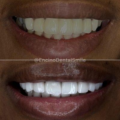 Smile makeover for our traveling patients