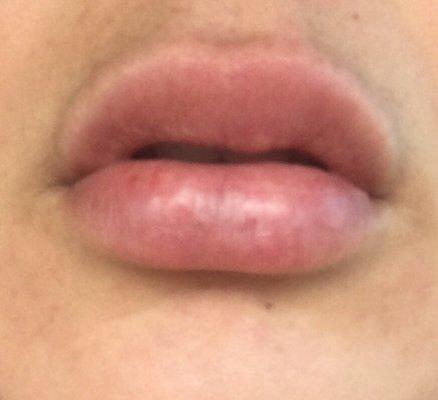 This picture does not do justice (its worse in person). First pic is where my top lip is uneven.