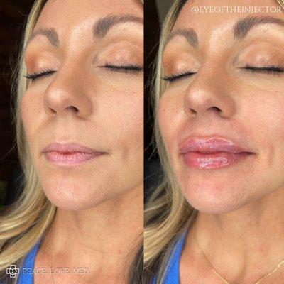 Lip Filler Injections!  Work by Erika at Peace Love Med Spa in Boca Raton, FL!