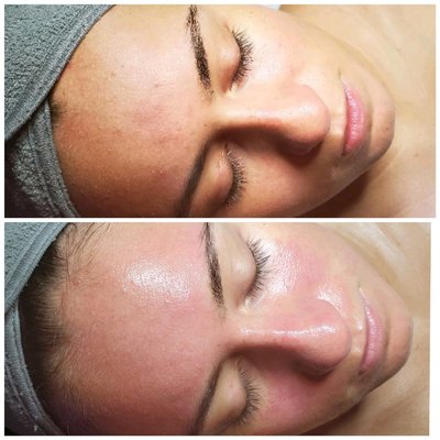 AMAZING results from HydraFacial