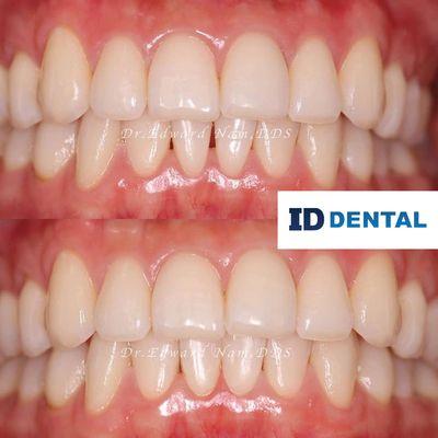 ID Dental Implant and Dental Care