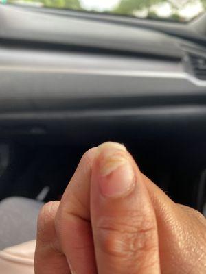 So much pain behind this. Nail split in half and squeezed inward to the point it changed my nail shape. It's also hard as a rock