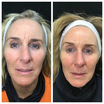 Microneedling can really decrease wrinkles.