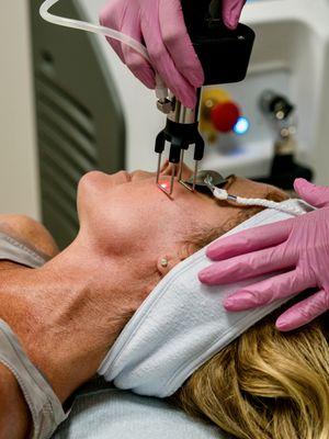 Tetra CoolPeel laser treatment performed by our RN Jackie Humphrey at Salt Spa and Wellness Center.