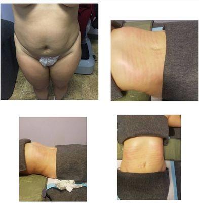 Cavitation Treatment