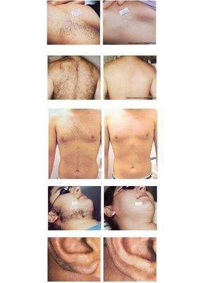 Never have to shave/wax again!? Laser Hair Removal for ALL areas of the body for men & women. We treat all skin types.