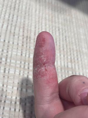 my finger after going to dial