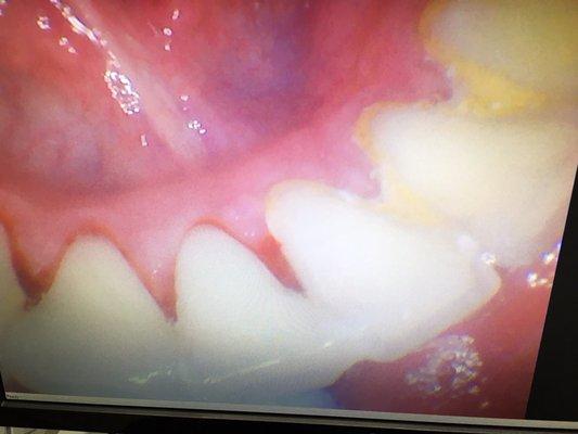 Left after, right before. All cleaned up thanks to Dr. Doan!