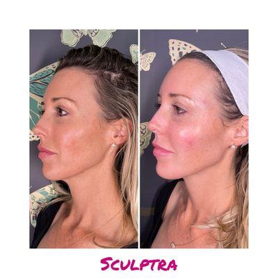 Sculptra before and after