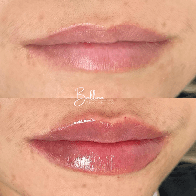 1ml of Restylane Kysse in Lips