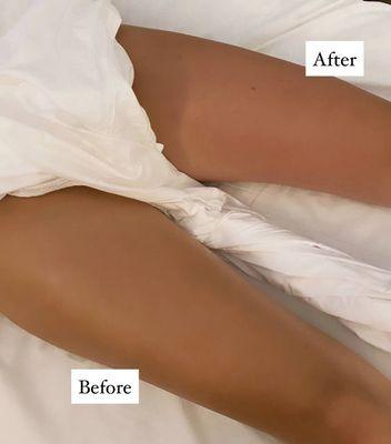 Before and after a lymphatic drainage massage session