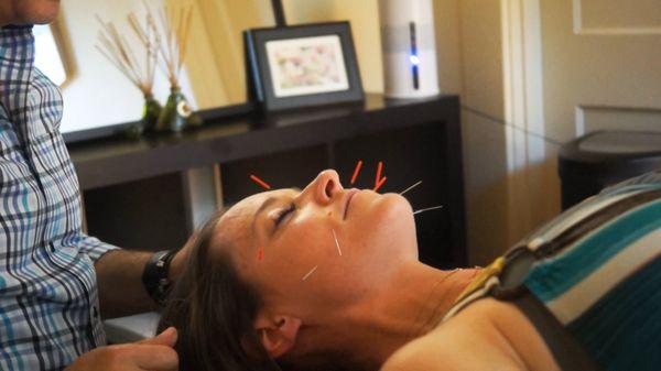 Cosmetic Acupuncture