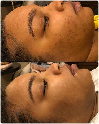 After 3 months on our clear-skin system.