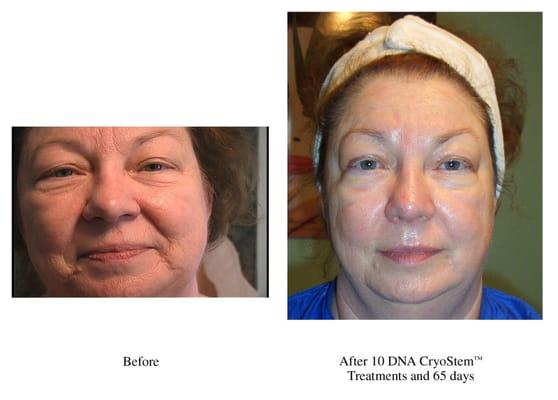 Another happy Stem Cell User!