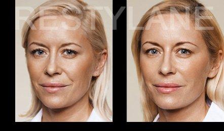 Dermal Fillers