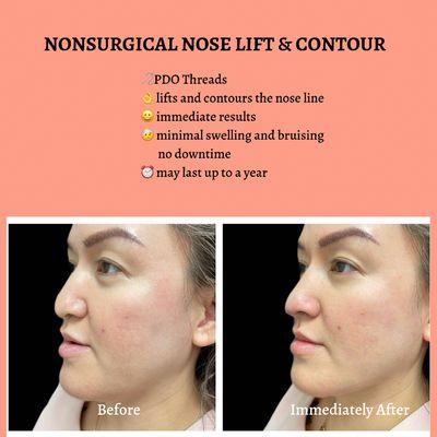 Nose PDO Thread Lift