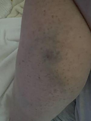 The bruise from bloodwork