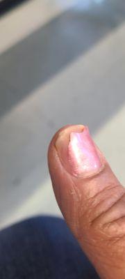 Peeling thumb 3 days later