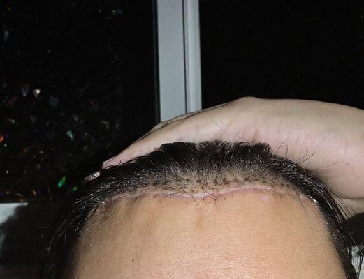 This is what the doctor fixed and shows what a proper hairline lowering procedure looks like