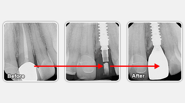 Dental Implant