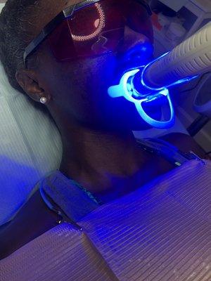 Teeth whitening