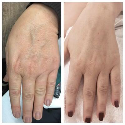 Hand rejuvenation by Microneedling