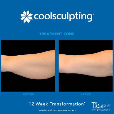 Ask if CoolSculpting is right for you!!!
 
 Buy 3 Treatments Get 1 FREE!!