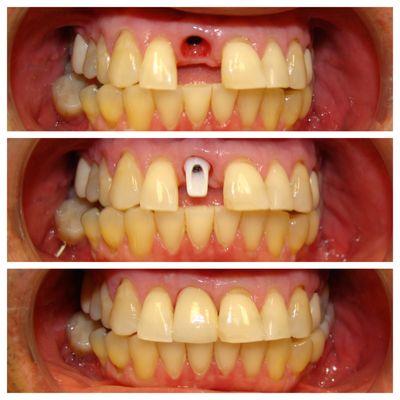 Broken tooth, zirconia abutment and implant crown; before and after.