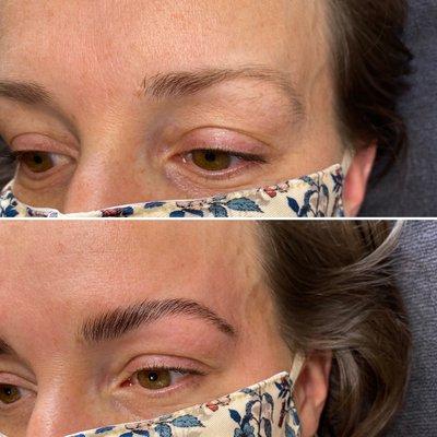 Brow lift