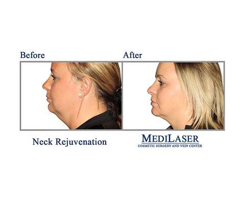 Neck-Rejuvenation-Cosmetic-Surgeon-Dr-Giraldo