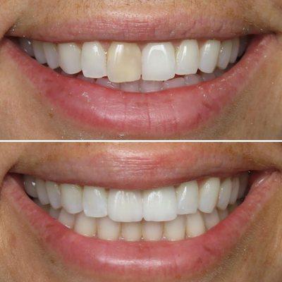 Another smile enhanced by Dr. Rob using veneers. Such a natural and cohesive result!