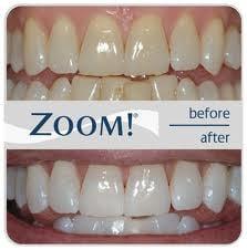 Pavlovich Dental offers two types of whitening services: Zoom Whitening and also tray whitening.