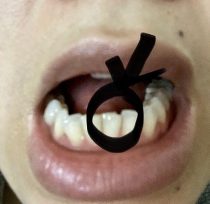 My chipped tooth