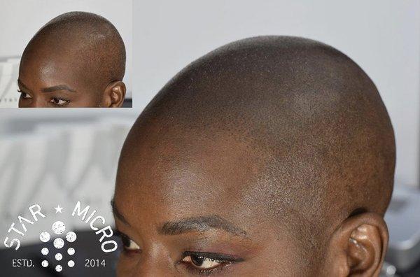 Alopecia on female client