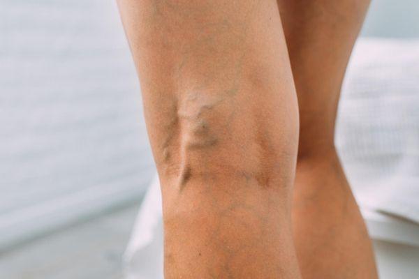 Varicose Vein