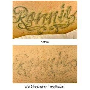 Laser tattoo removal. You can still change your mind!