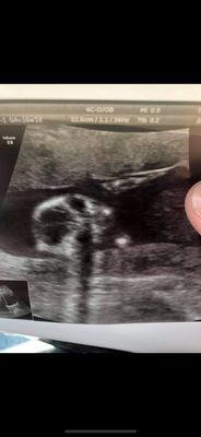 Ultrasound of baby's head