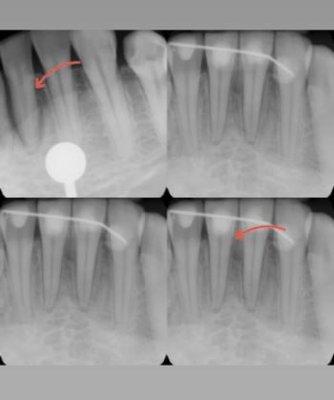 A before and after Osseous Surgery