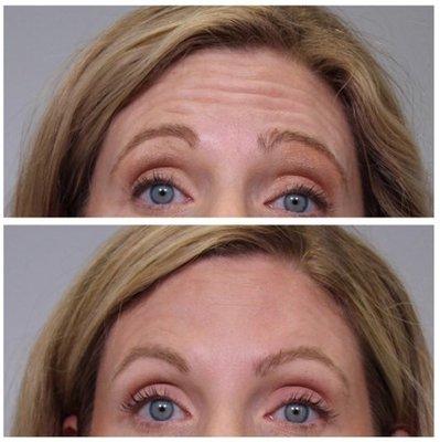 Botox Before and After