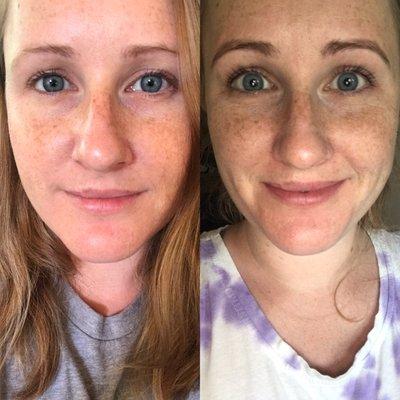 Eye brow shaping/tinting with eyelash tint before and after. No makeup or filters on either and taken within 24 hours of each other.