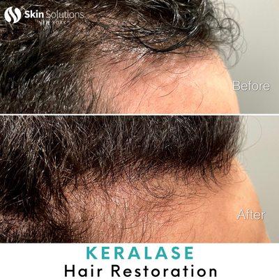 After just two Keralase Hair Restoration sessions, our patient's hair is showing improvement!