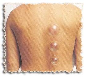 Cupping is a method of applying acupressure by creating a vacuum next to the patient's skin.