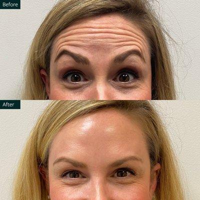 The Skin Center Before and After Botox