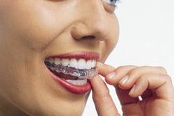 Straightening teeth with clear aligners