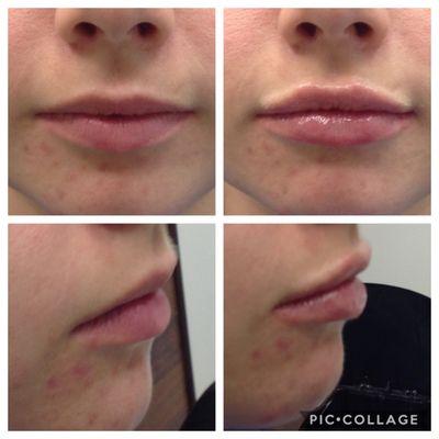 Before and after lip filler