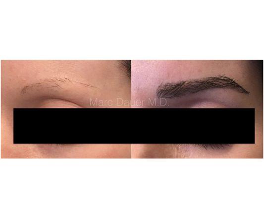 Left brow transplant before and after, performed by Dr. Dauer